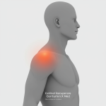 Recuperare durere umar Centurion X MED